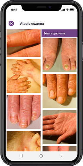 Picture from the app: Atopic eczema pictures