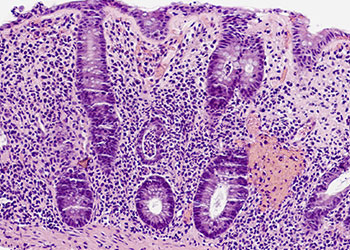 Tile Picture Best of Inflammatory Bowel Disease