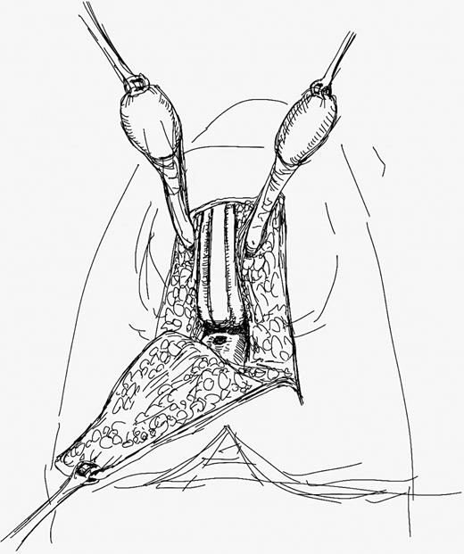 The mid-perineal scrotal flap (MPSF) incorporates all the subcutaneous tissue between the skin and the bulbar urethra. The testicles surrounded by the tunica vaginalis are completely freed and positioned temporarily over the lower abdomen. This approach allows a complete dissection of the proximal aspect of the urethra and exposure of the surgical plane between the rectum and the posterior aspect of the prostate.