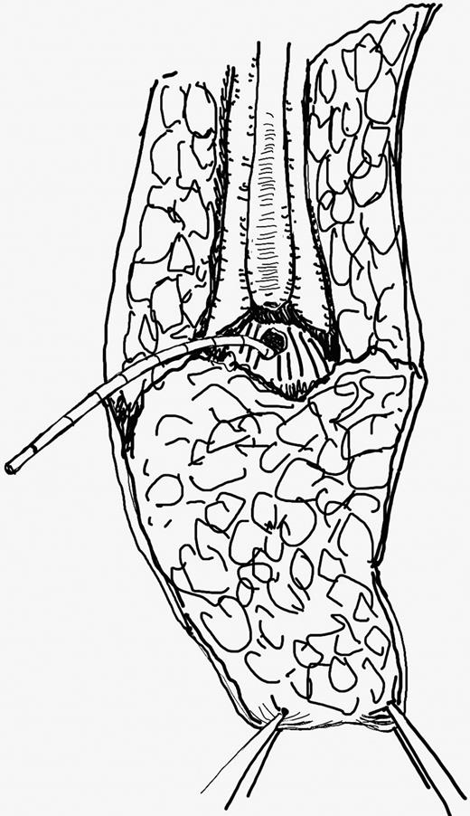 Identification of the fistula is facilitated by the previous insertion of the ureteric catheter through the fistula.