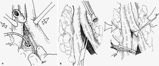 In case that a urethral stricture is associated with the fistula, an anastomotic urethroplasty is performed, either bulbo-prostatic or urethro-vesical in case that the patient had previously undergone a radical prostatectomy. Stepwise maneuvers of the elaborated perineal posterior urethroplasty may be used as necessary to achieve a tension-free anastomosis. The urethra is transected at the point of the fistula and mobilized distally beyond the crus as far as the penoscrotal junction. Then corporeal body separation in bloodless plane is performed from the crus distally for 3–5 cm (a). If after corporal body separation, and inferior wedge pubectomy, a tension-free anastomosis cannot be achieved, the urethra is routed around the lateral side of the left corporal body. A small furrow of the bone should be gouged from the left ischiopubic ramus where the urethra runs, to avoid its compression between the corpus and bone (b).