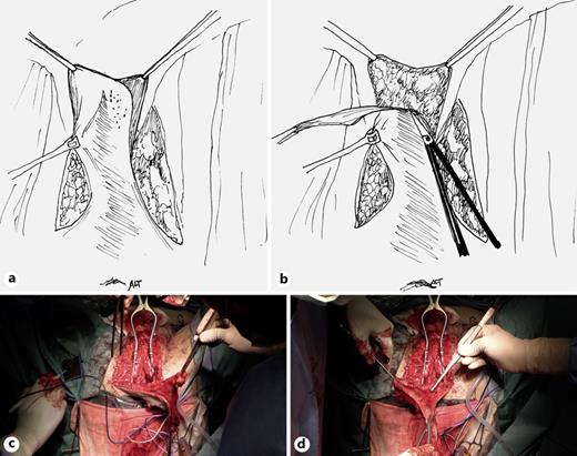 To avoid recurrence of the fistula, the distal aspect of the MPSF is de-epithelialized and used as interposition flap. De-epithelialization can be done with scalpel or scissors and care should be taken to avoid damage of the subcutaneous vascularization (a–d).