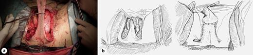 The distal skin of the flap devoted of subcutaneous fat tissue is resected (a). A drain is left, the testicles are repositioned to its original position, and the skin is closed. The remnant scrotal skin has enough elasticity to allow a tension-free closure of the scrotal skin (b).